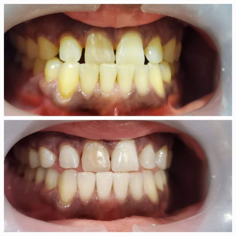 Professional Teeth Whitening